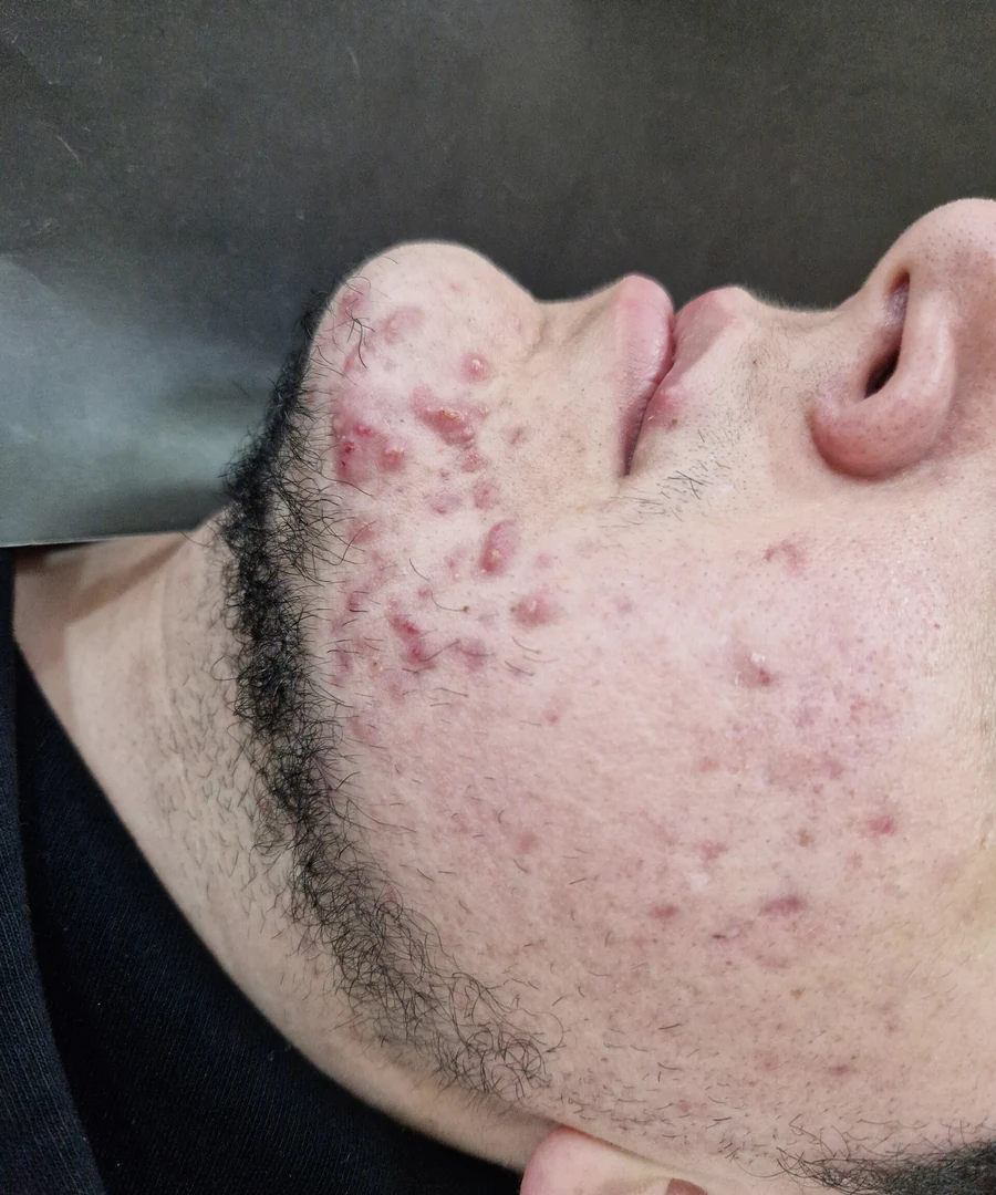 Licensed educational photograph showing blemish-prone skin